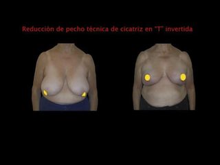 Reducción senos - Contour Clinic