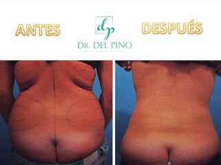 Liposucción - Clínica de estética Dr. del Pino
