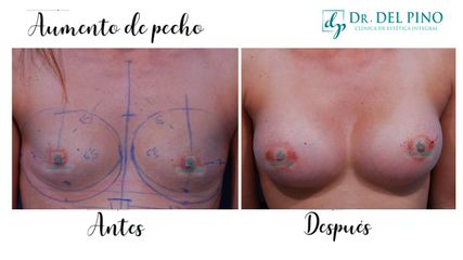Aumento de pecho - Clínica de estética Dr. del Pino