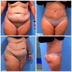Abdominoplastia - Clínica de estética Dr. del Pino