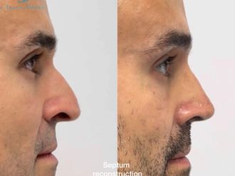 Rinoplastia antes y después - 872643