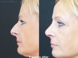 Rinoplastia antes y después - 872648