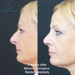 Rinoplastia