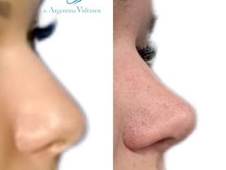 Rinoplastia antes y después - 872651