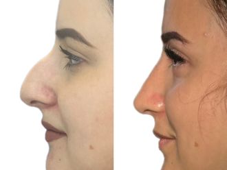 Rinoplastia antes y después - 872653