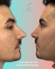 Rinoplastia masculina