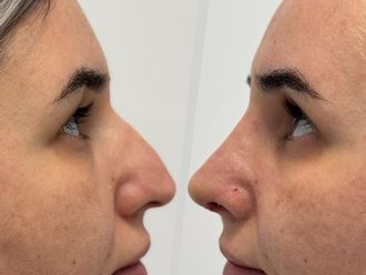 Rinoplastia antes y después - 878688