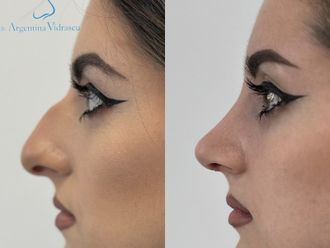 Rinoplastia antes y después - 878699