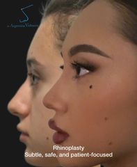 Rinoplastia