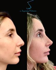 Rinoplastia