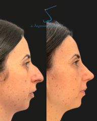 Rinoplastia