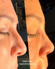 Rinoplastia