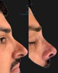 Rinoplastia