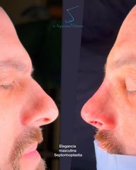 Rinoplastia
