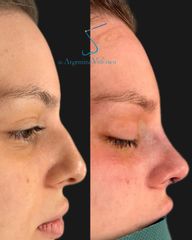 Rinoplastia