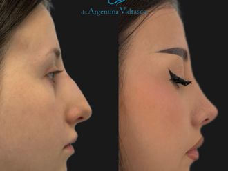 Rinoplastia antes y después - 879275