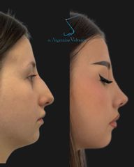 Rinoplastia