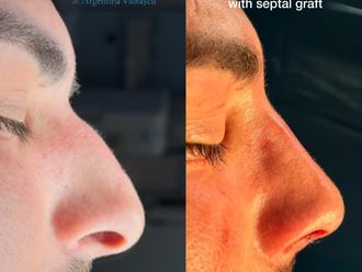 Rinoplastia antes y después - 879276