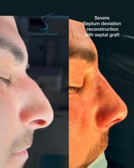 Rinoplastia