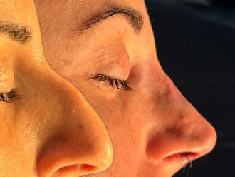 Rinoplastia antes y después - 879277