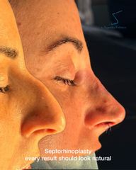 Rinoplastia