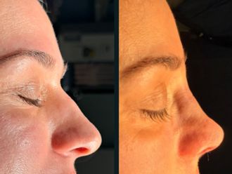 Rinoplastia antes y después - 879278