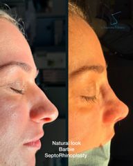 Rinoplastia