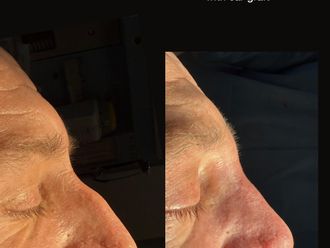 Rinoplastia antes y después - 879330