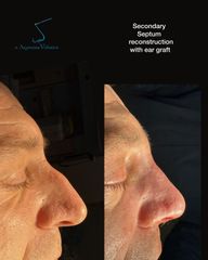 Rinoplastia