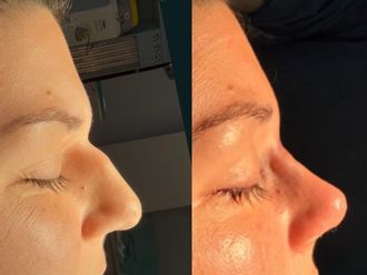 Rinoplastia antes y después - 879331