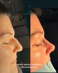 Rinoplastia