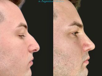 Rinoplastia antes y después - 879332