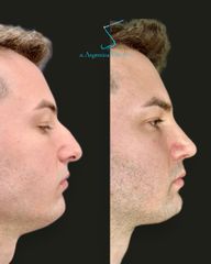 Rinoplastia
