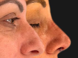 Rinoplastia antes y después - 879333