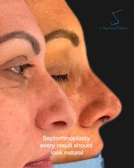 Rinoplastia
