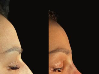 Rinoplastia antes y después - 879334
