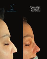 Rinoplastia