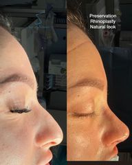 Rinoplastia