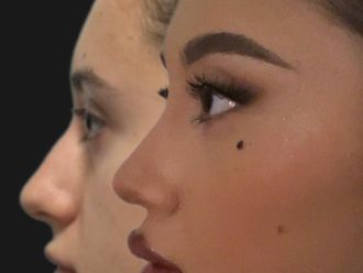 Rinoplastia antes y después - 879336