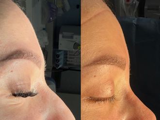 Rinoplastia antes y después - 879337