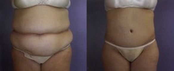 Antes y después Abdominoplastia