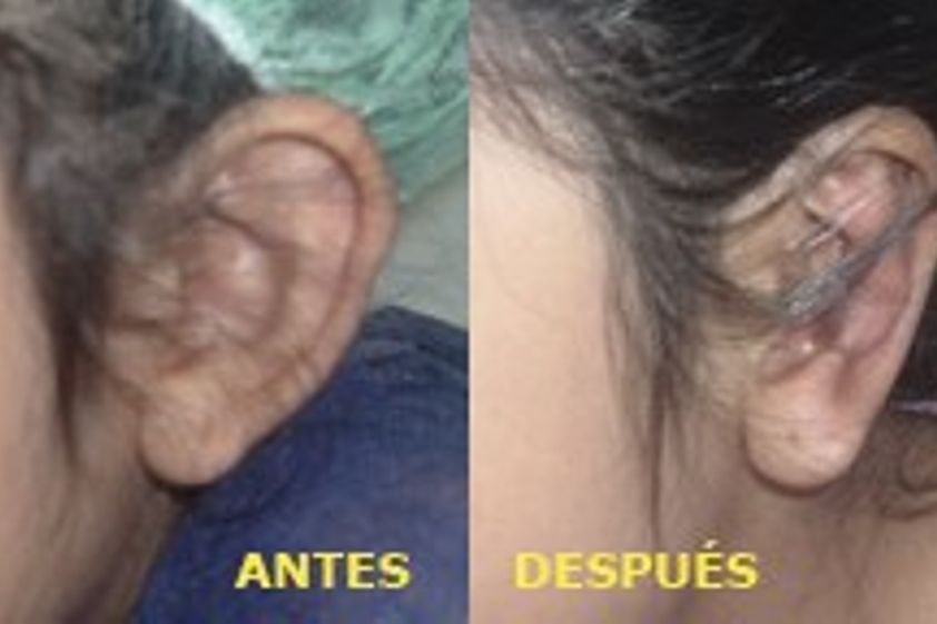 Otoplastia antes y después - 138044