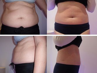 Tratamiento antigrasa - 612674