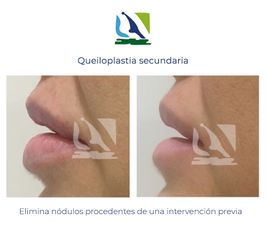 Queiloplastia secundaria - Centro Clínico Quirúrgico Aranjuez