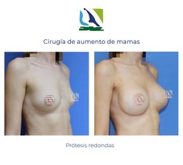 Aumento de mamas con implantes redondos - Centro Clínico Quirúrgico Aranjuez