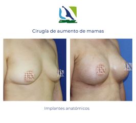 Aumento de mamas con implantes anatómicos - Centro Clínico Quirúrgico Aranjuez