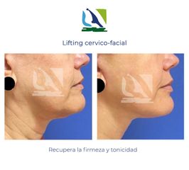 Lifting cervico-facial - Centro Clínico Quirúrgico Aranjuez