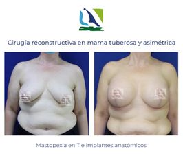 Reconstrucción de mama - Centro Clínico Quirúrgico Aranjuez