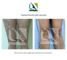 Tratamiento de varices - Centro Clínico Quirúrgico Aranjuez