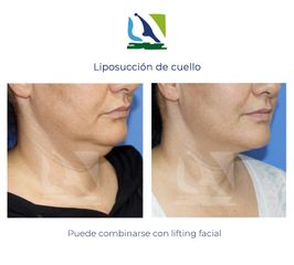 Liposucción de cuello - Centro Clínico Quirúrgico Aranjuez